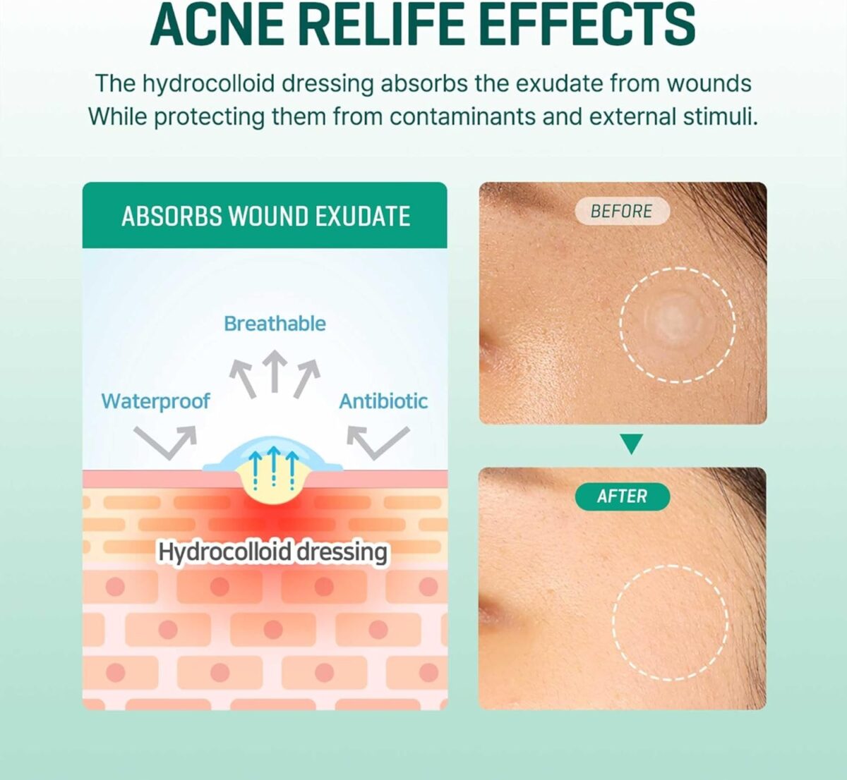⁦SOME BY MI Miracle Acne Removal Patches 18 pieces⁩ - الصورة ⁦3⁩